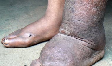 से 25 फरवरी तक चलेगा फाइलेरिया उन्मुलन अभियान  फाइलेरिया उन्मुलन के लिए हर व्यक्ति का दवा सेवन जरूरी