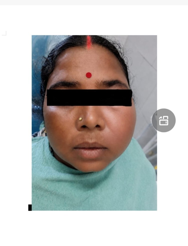 सिम्स में 38 वर्षीय महिला के रेडिकुलर सिस्ट का सफल उपचार